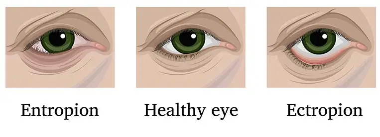 Entropion