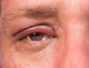 Lid and Oculoplastic