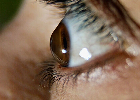 keratoconus Treatment in Andheri Mumbai