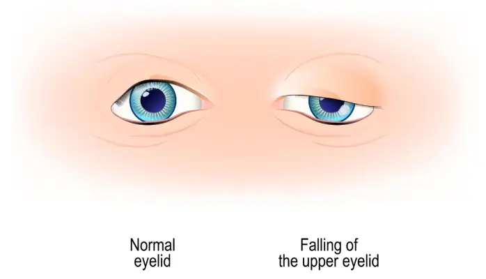 Eyelid Ptosis